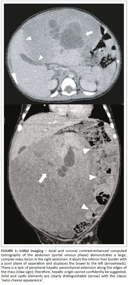 Hepatic Mesenchymal Hamartoma An Uncommon But Important Paediatric