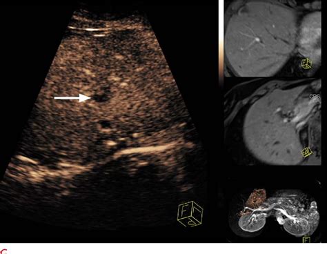 Figure 1 From Benefits Of Contrast Enhanced Ultrasonography For