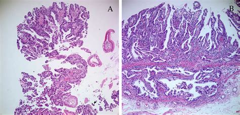 Gastric Carcinoma Morphologic Classifications And Molecular Changes