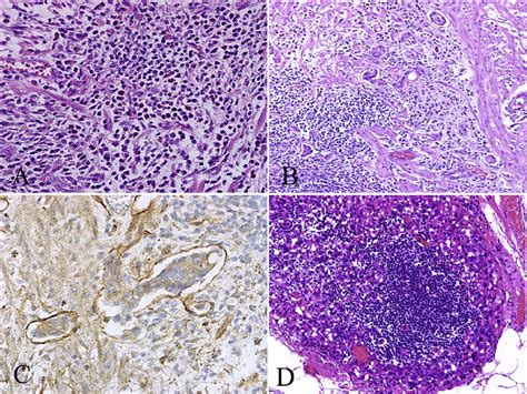 Hematoxylin And Eosin Hande And Immunohistochemical Staining In The