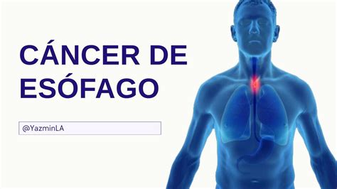 Presentación Sobre Cáncer De Esófago Yazmin La Udocz