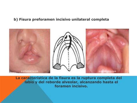 Fisura Labio Naso Alveolo Palatina Ppt Descarga Gratuita