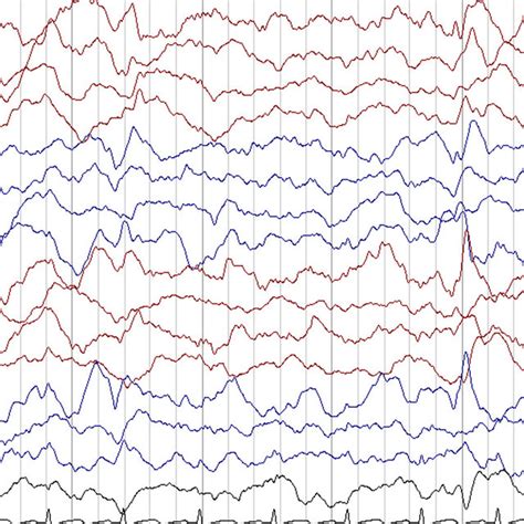 Eeg With Bipolar Longitudinal Montage At Year Of Age With Occasional