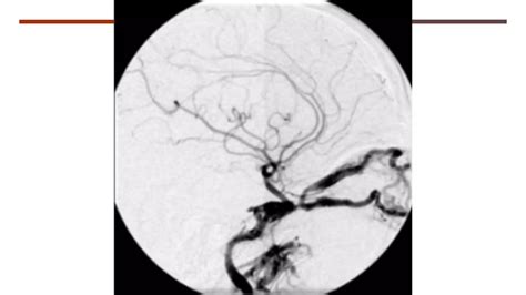 Unilateral Ophthalmoplegia Ppt