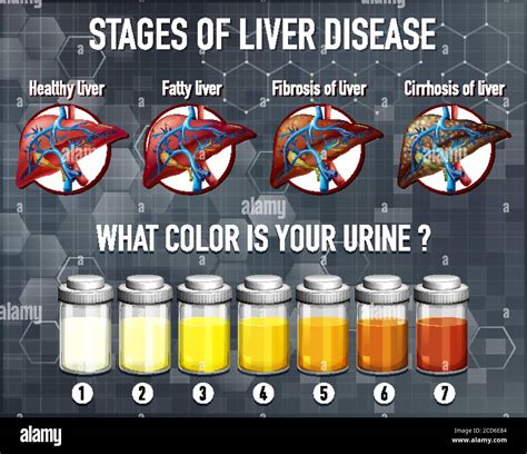 Ilustración de las etapas de la enfermedad hepática Imagen Vector de
