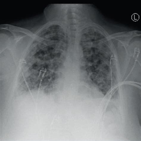 C T Chest Angiogram Showing Diffuse Multifocal Nodular Opacities