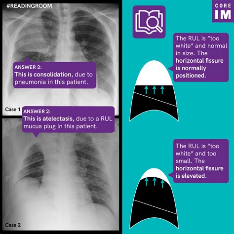 Lung Consolidation Vs Pleural Effusion