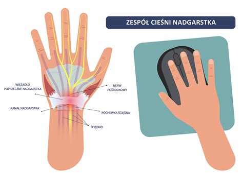 Odszkodowanie po operacji cieśni nadgarstka odszkodowanie za operację