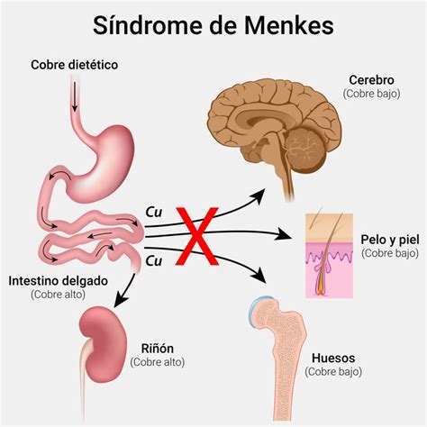 Síndrome De Menkes Qué Es Causas Síntomas Y Tratamiento