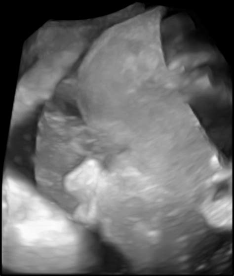 Third Trimester Ultrasound Three Dimensional Reconstruction Of The