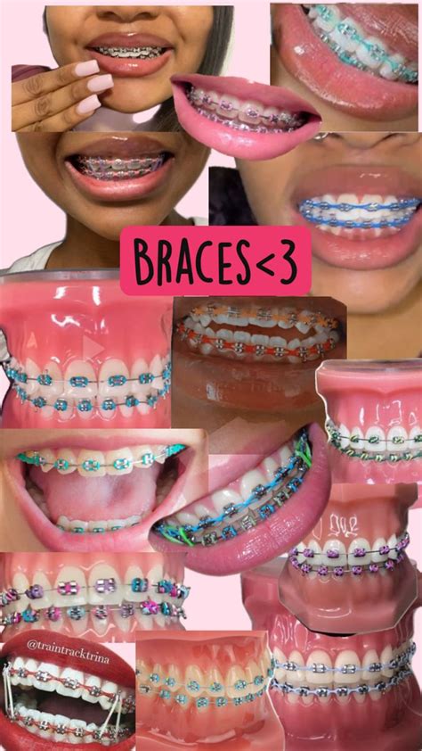 Braces