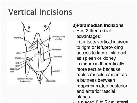 Surgical Incisions