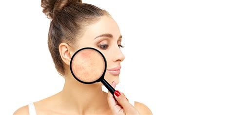 Blemishes On Face: Causes, Types And Treatments, 59% OFF