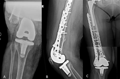 69 Year Old With Open Supracondylar Distal Femur Fracture Patient Is