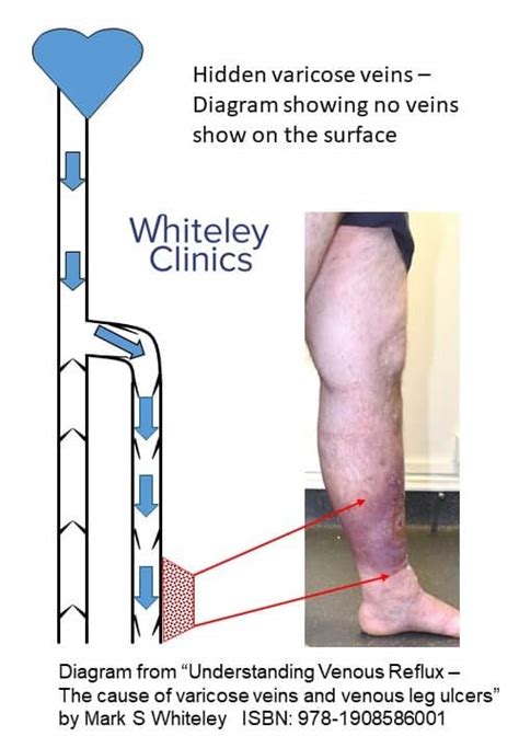 Hidden Varicose Veins Superficial Vein Reflux Treatment