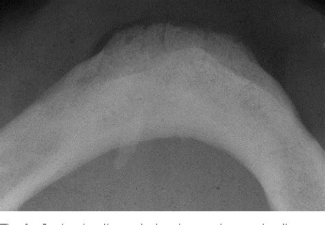 Figure 3 From Chronic Sclerosing Sialadenitis Or Küttners Tumor