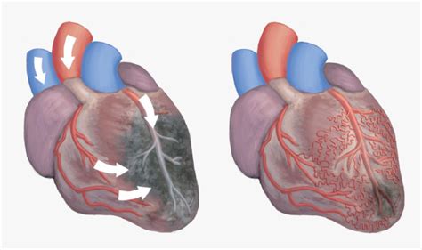 Alt="illustration Of Two Hearts, One Showing Ischemia - Eecp Effects On ...