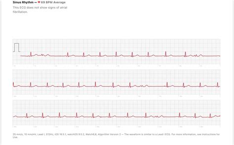 PVC’s on ECG : r/PVCs