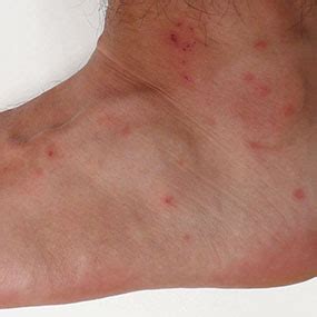 Chigger Bites: Treatment, Prevention, and Symptoms