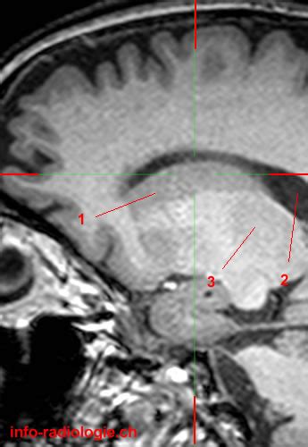 Caudate Nucleus W Radiology