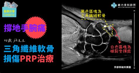 手腕撐地痛三角纖維軟骨受傷PRP治療 維力骨科診所