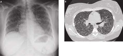 A Chest Radiograph Demonstrates Diffuse Bilateral Pulmonary Download Scientific Diagram