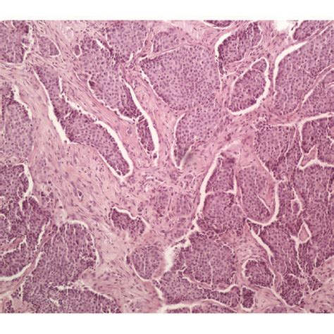 Lobules And Cords Of Aggressive Digital Papillary Adenocarcinoma H