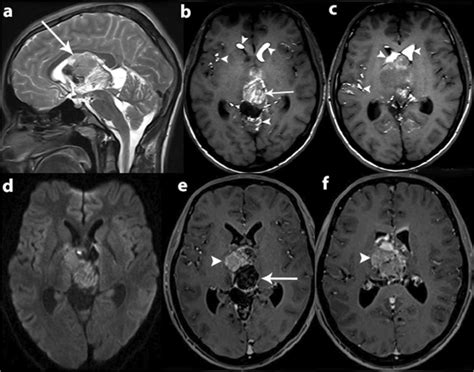 Preoperative Magnetic Resonance Mr Imaging Sagittal T2 Weighted Mr Download Scientific