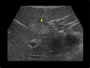 Abdomen and retroperitoneum | 1.1 Liver : Case 1.1.11 Fatty liver and focal sparing | Ultrasound ...