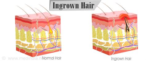 Ingrown Hair Cyst Symptoms Treatment Prevention And 52 Off