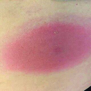 Erythema migrans in a patient with Lyme disease at initial ...