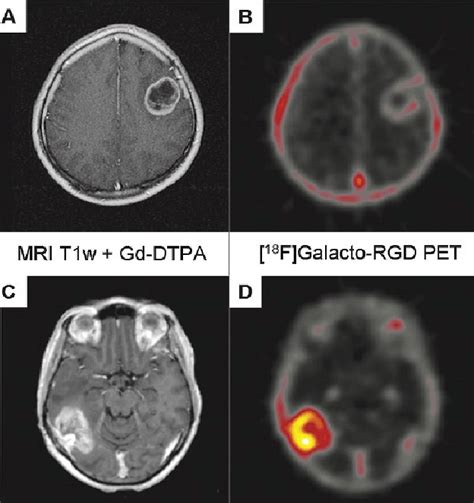 Examples Of Patients With Glioblastoma Multiforme Of The Left Frontal