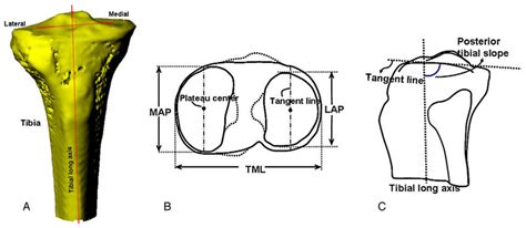 Tibial Measurements A Tibial Coordinate System B Measurements Of