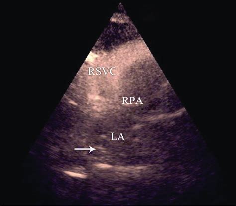 Transthoracic Echocardiography In The Suprasternal Notch View Showing