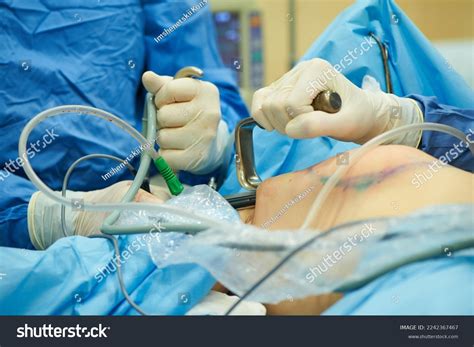 Surgical Breast Plastic Surgery Through Armpit Stock Photo 2242367467 ...