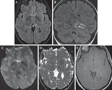 JLE Epileptic Disorders Unilateral Thalamic Lesion Mimicking