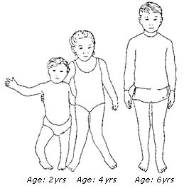 Bowlegs and Knock-Knees | Rady Children's Hospital