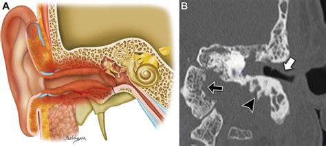 Necrotizing Otitis Externa