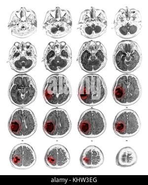 MRI Brain Mostra Tumore Al Cervello A Destra Del Lobo Parietale Del