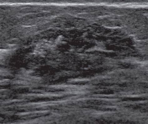 Us Appearance Of Ductal Carcinoma In Situ Radiographics