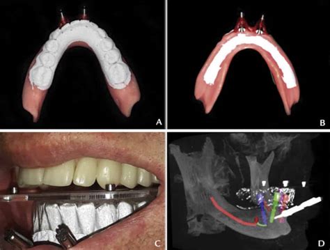 Guided Implant Surgery Workflow In Edentulous Patients A Precise And