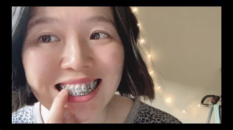 成人牙套3个月update Adult Braces 3 Month Update Youtube