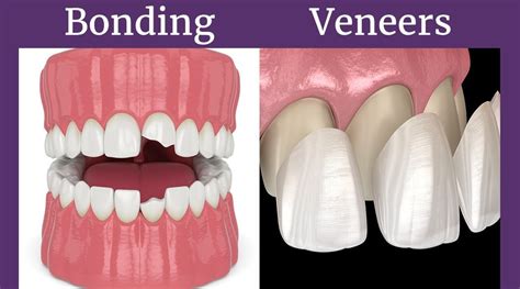 Bonding Or Veneers What Is Right For You Weisbard Dental