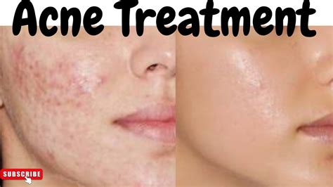 Acne Treatment At Home Get Rid Of Pimples Permanently Acne Scars Dark