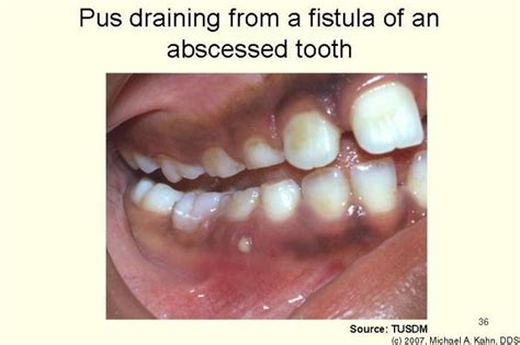 7 best Gross teeth images on Pinterest | Dental, Teeth and Tooth