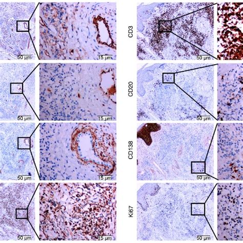 Histopathological characteristics of angiolymphoid hyperplasia with... | Download Scientific Diagram