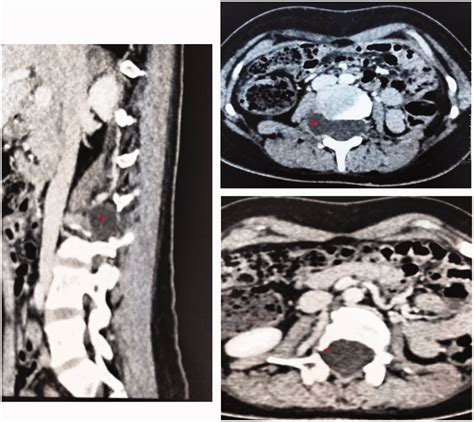 Follow Up Computed Tomography Scan Showing An Aspect Resembling A