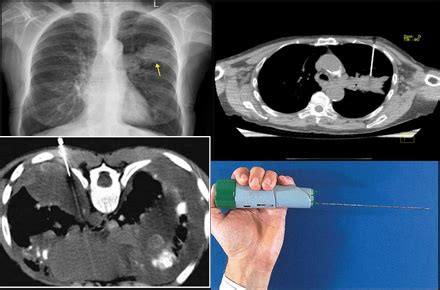 CT Scan Guided Procedures Biopsies Drainage Needle Placement