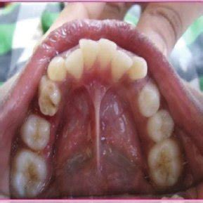 Orthopantomograph Showing Mandibular Left Primary Second Molar