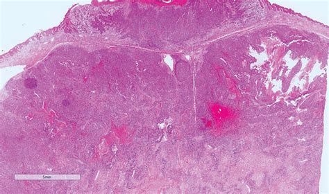 A Case Of Massive Porocarcinoma The Annals Of The Royal College Of